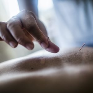 Close up of hand holding fine needle, performing acupuncture on a patient's back